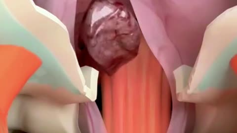 Brain Tumor Surgery - She survived a brain tumor surgery... What happened next sh