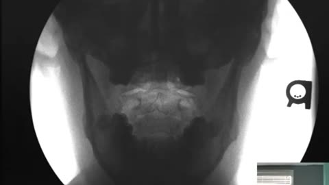 Digital Motion Xray (DMX) - Open Mouth Lateral Bending Views