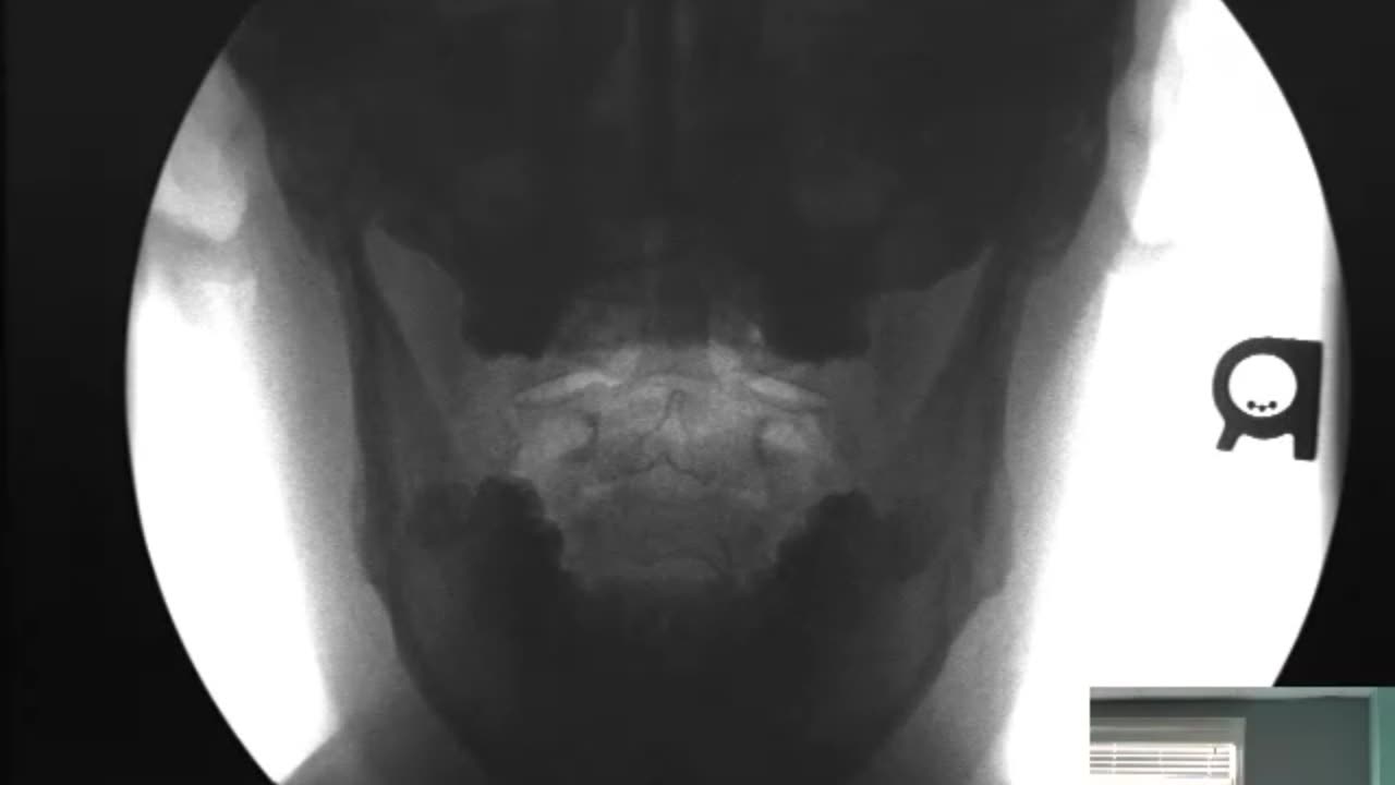 Digital Motion Xray (DMX) - Open Mouth Lateral Bending Views