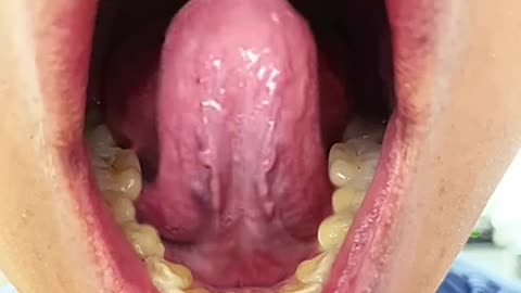 Tongue Tie: Severity Grades 1-4 (Tongue Range of Motion Ratio)