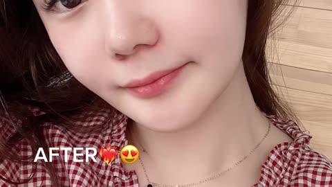 Plastic surgery transformation in Korea #idhospital #shorts