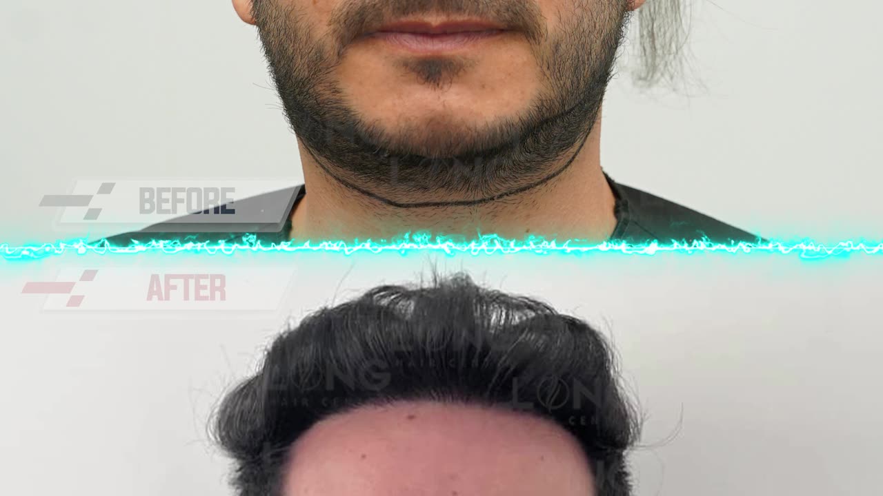 We know that hair loss can be a really tough experience. It can really knock your confidence