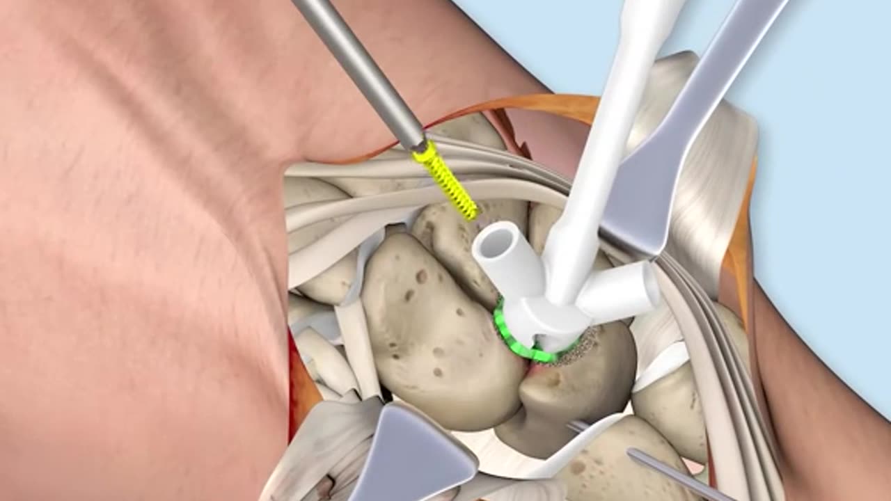 Degenerative Hand Treatment Surgery 3D Animation
