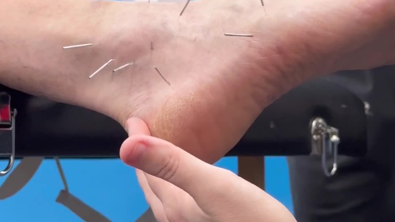 Heel Pain Relief: Advanced Dry Needling Techniques You NEED to Know!
