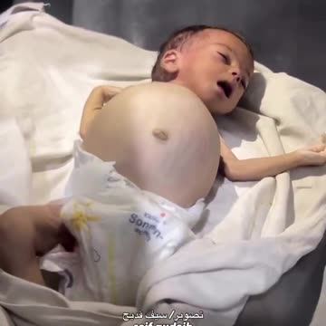 The infant Raseel Khaled Abu Masoud has died as a result of severe malnutrition