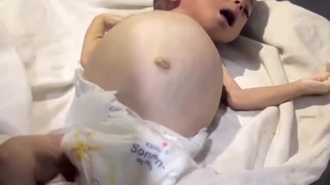 The infant Raseel Khaled Abu Masoud has died as a result of severe malnutrition