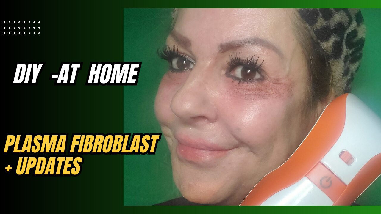 DIY AT - HOME PLASMA FIBROBLAST UNDER EYES + UPDATES