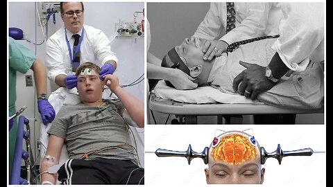 ALL ABOUT BRAIN BURNING ELECTROSHOCKS ECT IN MK ULTRA