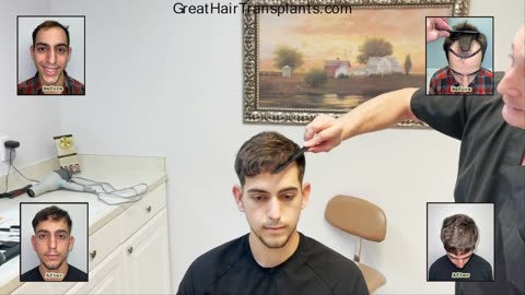Patient Adrian’s High-Density MaxHarvest™ Hair Transplant