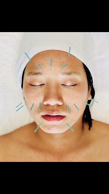 Acupuncture Treatment Toronto: Natural Relief for Pain and Stress