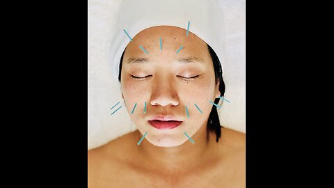 Acupuncture Treatment Toronto: Natural Relief for Pain and Stress