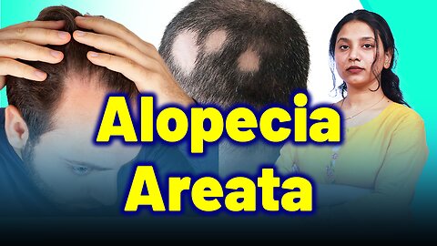 Patchy hair loss, Alopecia Areata, Spot baldness.| Treatment Cure Relief Medicine | Skin Hair Nail