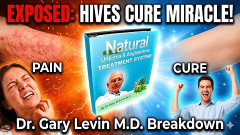 Full Urticaria Cure by Dr. Gary M Levin M.D. Exposed – Natural Hives Fix That Works? 2025