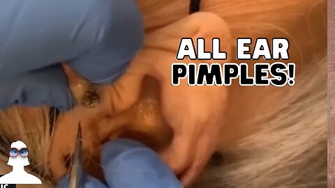 16 Minutes of Ear PIMPLES
