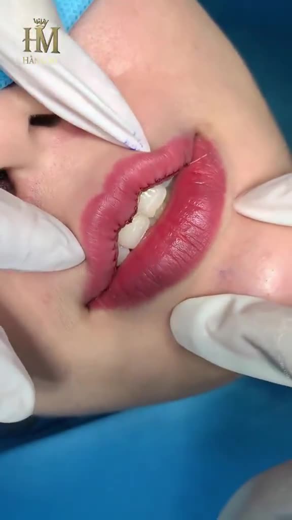 Heart lip cosmetic surgery