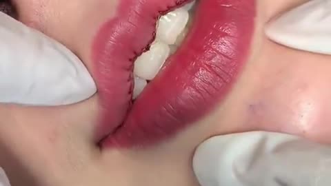 Heart lip cosmetic surgery
