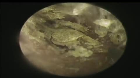 Earwax and Dead Skin Are Full On Both Sides
