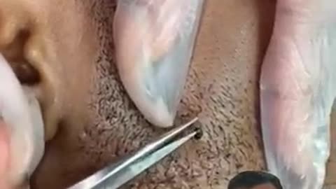 Must Watch: Cosmetic surgeon reacts to ingrown hair | Dr. Somji