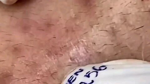 Top Blackhead Removal 2025 | Super Satisfying Giant Whitehead Explosion Caught on Camera 😳