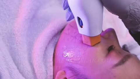 Thermage Skin Tightening – Non-Surgical Lift for a Youthful Look