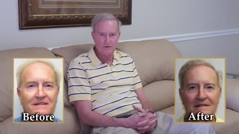 Hair Transplant Surgery by Dr. Brett Bolton | MaxHarvest™ Procedure