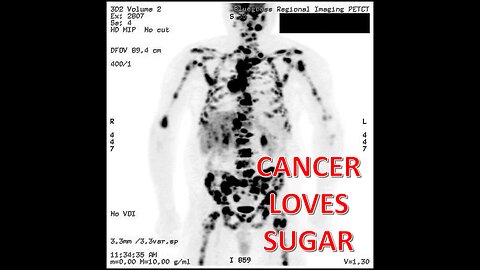 CANCER ❤ SUGAR