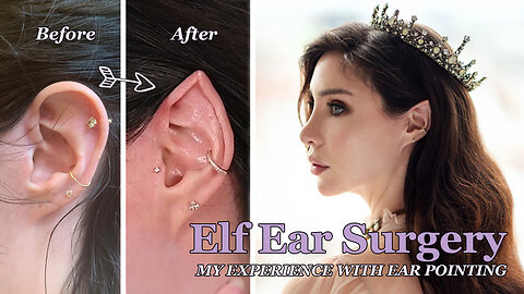 Elf Ear Surgery! My Experience