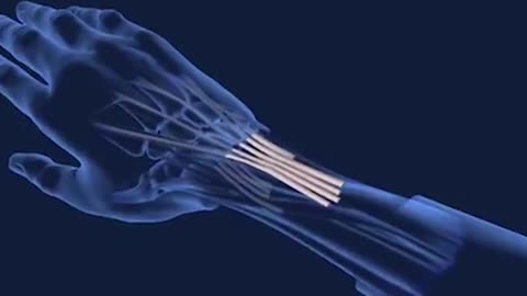 Human Hand Transplant Surgery 3D Animation
