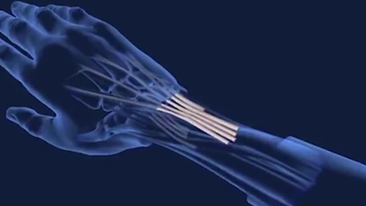 Human Hand Transplant Surgery 3D Animation