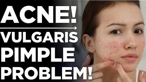 Acne: Why It Happens & How to Treat It😟 | Medickpidia