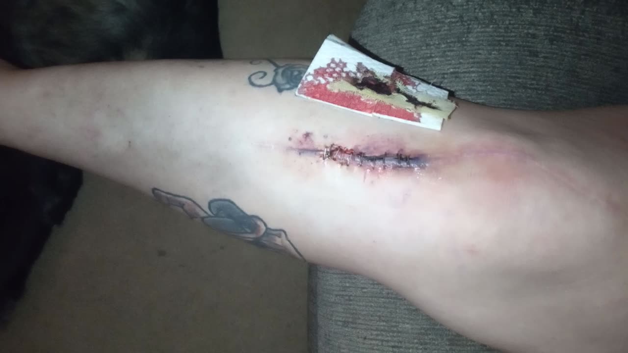 Amy Stacey 24 hrs after removing