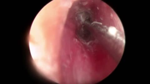 It's not Ear Wax but Pus in the ear _ Ear Infection