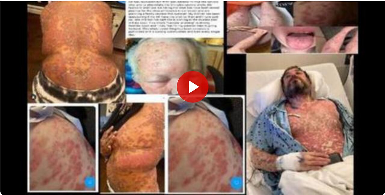 Alarming: Experimental Covid Vaccines now proving to be extremely toxic to humans