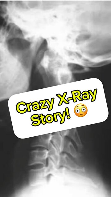 Crazy x-ray story!