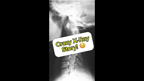 Crazy x-ray story!