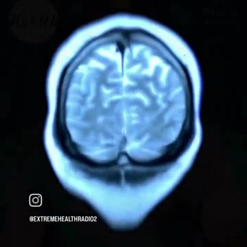 Groundbreaking Alzheimer's Cure...