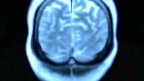 Groundbreaking Alzheimer's Cure...