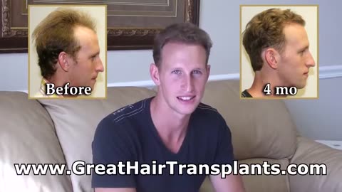 Rapid Hair Restoration: 4-Month Results with Dr. Brett Bolton