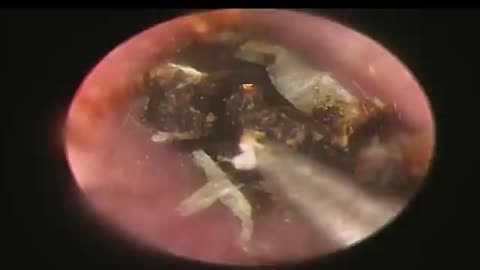 BIGGEST Earwax, Difficult Removal