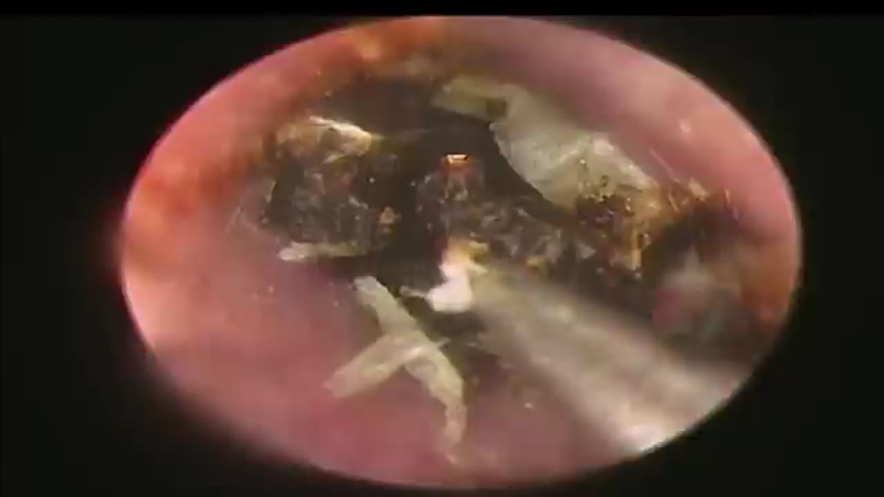 BIGGEST Earwax, Difficult Removal
