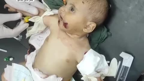 A Palestinian baby was injured after an Israeli strike hit a tent sheltering displaced civilians