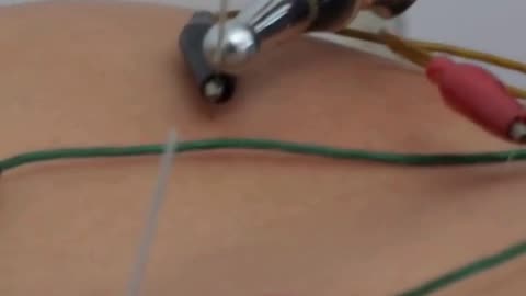 IMS Dry Needling in Maple Ridge | Pain Relief & Muscle Recovery at Golden Maple Physiotherapy