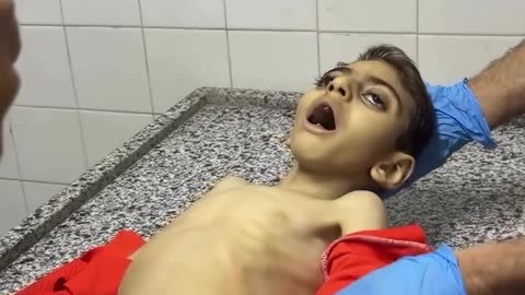 8-year-old Mustafa Yassin died of malnutrition and vitamin deficiency
