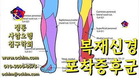 복재신경 포착증후군 치료 - 사암침법, 사암오행침, 오행침, 정통사암침