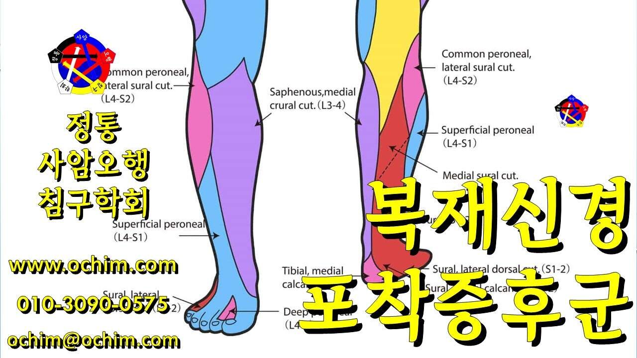복재신경 포착증후군 치료 - 사암침법, 사암오행침, 오행침, 정통사암침