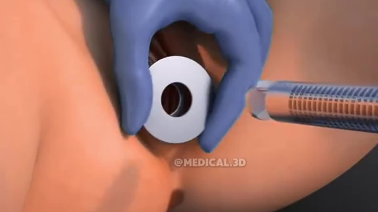 Monalisa Touch Procedure (3D Animation)