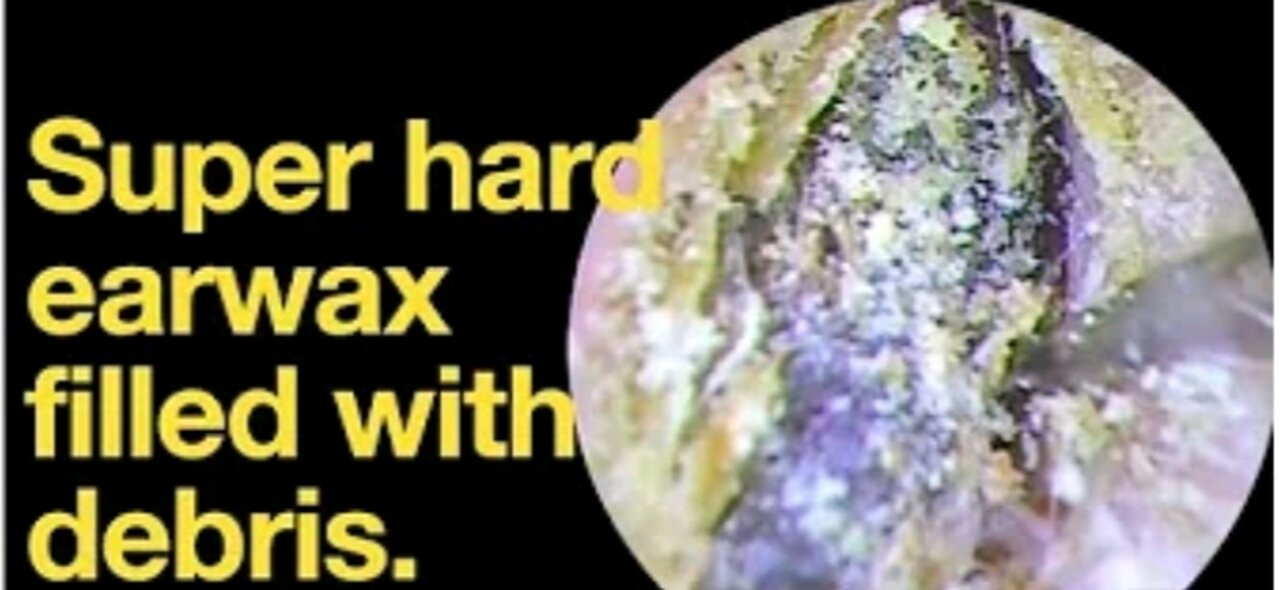 Super Hard Earwax Filled With Debris
