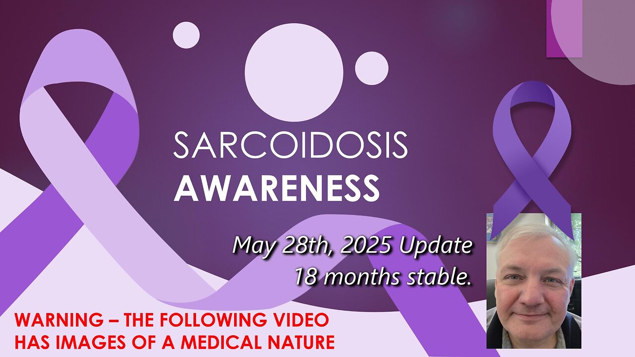 My Sarcoidosis Journey - May 28, 2025 Update