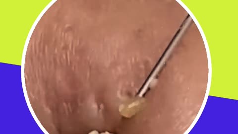 Blackhead removal new this week (ASMR) #3 #shorts