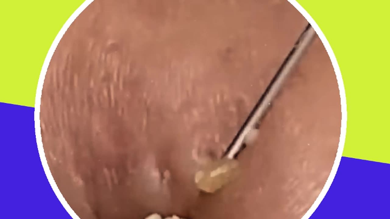 Blackhead removal new this week (ASMR) #3 #shorts